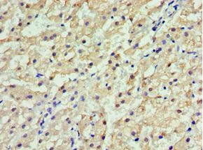 GSTA2 Antibody - Immunohistochemistry of paraffin-embedded human liver cancer using antibody at 1:100 dilution.