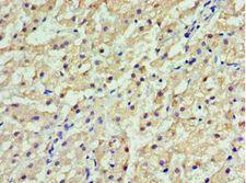 GSTA2 Antibody - Immunohistochemistry of paraffin-embedded human liver cancer using antibody at 1:100 dilution.