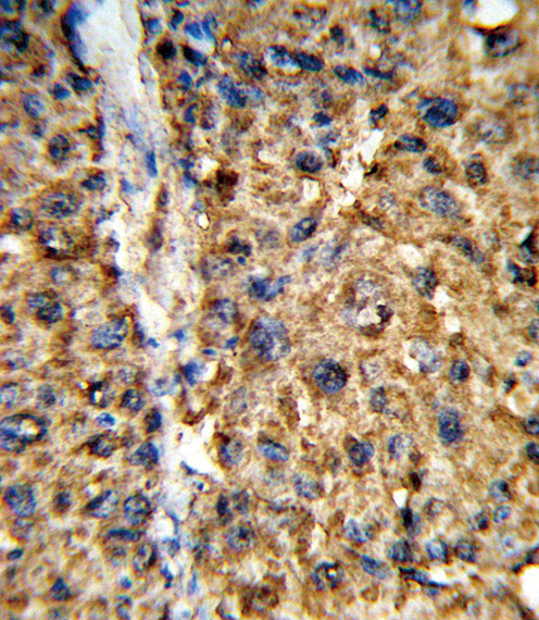 GSTA2 Antibody - Formalin-fixed and paraffin-embedded human hepatocarcinoma reacted with GSTA2 Antibody , which was peroxidase-conjugated to the secondary antibody, followed by DAB staining. This data demonstrates the use of this antibody for immunohistochemistry; clinical relevance has not been evaluated.