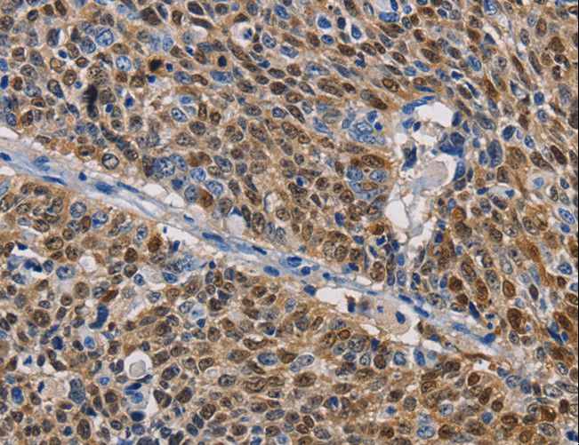 GSTA2 Antibody - Immunohistochemistry of paraffin-embedded Human lung cancer using GSTA2 Polyclonal Antibody at dilution of 1:50.