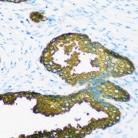 GSTA2 Antibody - Immunohistochemical analysis of GSTA2 staining in human prostate cancer formalin fixed paraffin embedded tissue section. The section was pre-treated using heat mediated antigen retrieval with sodium citrate buffer (pH 6.0). The section was then incubated with the antibody at room temperature and detected using an HRP conjugated compact polymer system. DAB was used as the chromogen. The section was then counterstained with hematoxylin and mounted with DPX.