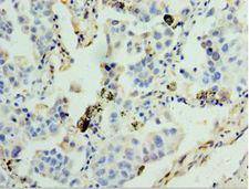 GSTA4 Antibody - Immunohistochemistry of paraffin-embedded human lung cancer using antibody at 1:100 dilution.