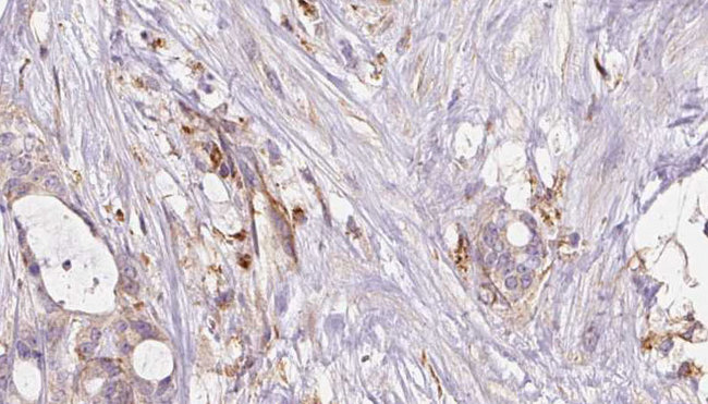 GSTA4 Antibody - 1:100 staining human liver carcinoma tissues by IHC-P. The sample was formaldehyde fixed and a heat mediated antigen retrieval step in citrate buffer was performed. The sample was then blocked and incubated with the antibody for 1.5 hours at 22°C. An HRP conjugated goat anti-rabbit antibody was used as the secondary.