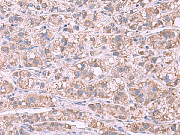 GSTCD Antibody - Immunohistochemistry of paraffin-embedded Human liver cancer tissue  using GSTCD Polyclonal Antibody at dilution of 1:70(×200)