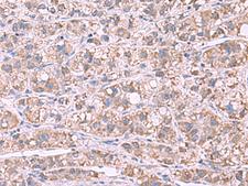 GSTCD Antibody - Immunohistochemistry of paraffin-embedded Human liver cancer tissue  using GSTCD Polyclonal Antibody at dilution of 1:70(×200)