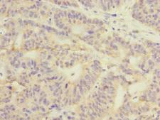 GSTK1 Antibody - Immunohistochemistry of paraffin-embedded human colon cancer at dilution 1:100