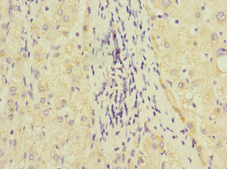 GSTK1 Antibody - Immunohistochemistry of paraffin-embedded human liver cancer at dilution 1:100