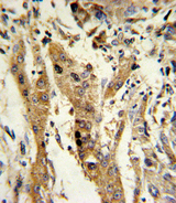 GSTM1 Antibody - Formalin-fixed and paraffin-embedded human hepatocarcinoma reacted with GSTM1 Antibody , which was peroxidase-conjugated to the secondary antibody, followed by DAB staining. This data demonstrates the use of this antibody for immunohistochemistry; clinical relevance has not been evaluated.