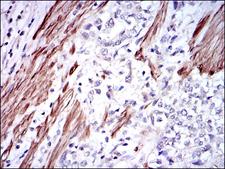 GSTM1 Antibody - IHC of paraffin-embedded rectum cancer tissues using GSTM1 mouse monoclonal antibody with DAB staining.