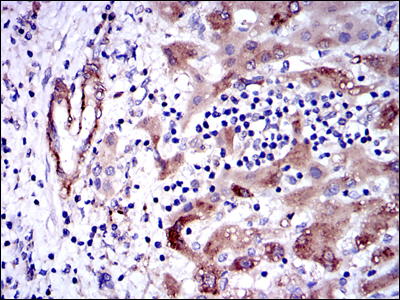 GSTM1 Antibody - IHC of paraffin-embedded liver cancer tissues using GSTM1 mouse monoclonal antibody with DAB staining.