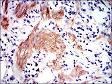 GSTM1 Antibody - IHC of paraffin-embedded stomach cancer tissues using GSTM1 mouse monoclonal antibody with DAB staining.