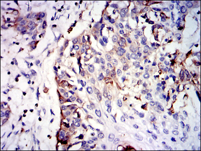 GSTM1 Antibody - IHC of paraffin-embedded esophageal cancer tissues using GSTM1 mouse monoclonal antibody with DAB staining.