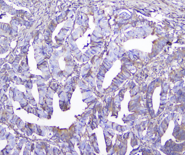 GSTM1 Antibody - IHC analysis of GSTM1 using anti-GSTM1 Antibody. GSTM1 was detected in paraffin-embedded section of human colon cancer tissue. Heat mediated antigen retrieval was performed in citrate buffer (pH6, epitope retrieval solution) for 20 mins. The tissue section was blocked with 10% goat serum. The tissue section was then incubated with 2µg/ml mouse anti-GSTM1 Antibody overnight at 4°C. Biotinylated goat anti-mouse IgG was used as secondary antibody and incubated for 30 minutes at 37°C. The tissue section was developed using Strepavidin-Biotin-Complex (SABC) with DAB as the chromogen.
