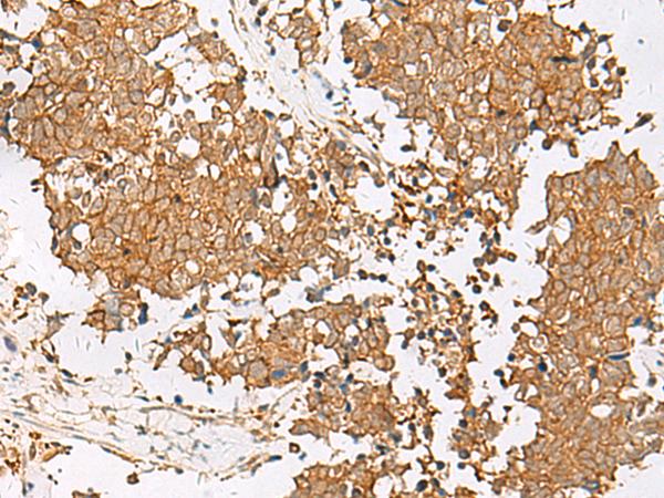 GSTM1 Antibody - Immunohistochemistry of paraffin-embedded Human lung cancer tissue  using GSTM2 Polyclonal Antibody at dilution of 1:50(×200)