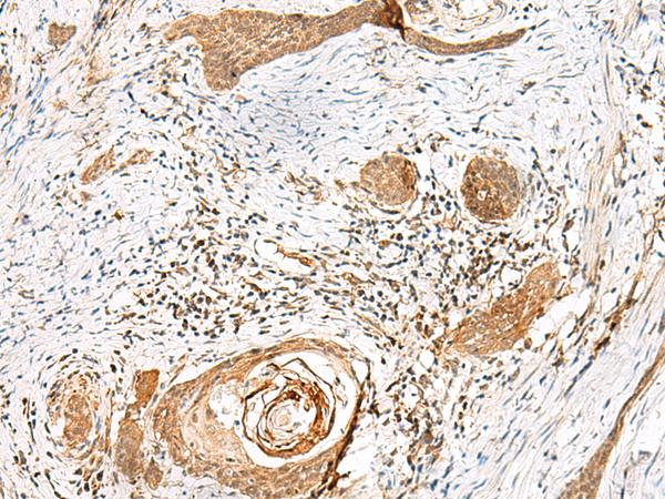 GSTM1 Antibody - Immunohistochemistry of paraffin-embedded Human esophagus cancer tissue  using GSTM2 Polyclonal Antibody at dilution of 1:50(×200)