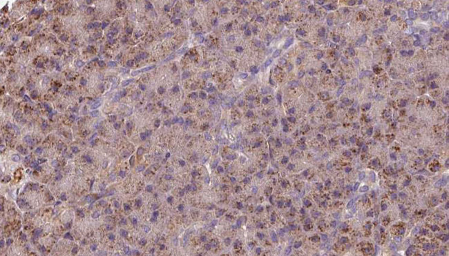 GSTM3 Antibody - 1:100 staining human pancreas carcinoma tissue by IHC-P. The sample was formaldehyde fixed and a heat mediated antigen retrieval step in citrate buffer was performed. The sample was then blocked and incubated with the antibody for 1.5 hours at 22°C. An HRP conjugated goat anti-rabbit antibody was used as the secondary.