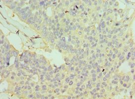 GSTO2 Antibody - Immunohistochemistry of paraffin-embedded human endometrial cancer using antibody at 1:100 dilution.