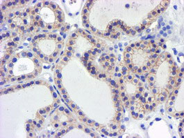 GSTO2 Antibody - IHC of paraffin-embedded Carcinoma of Human thyroid tissue using anti-GSTO2 mouse monoclonal antibody.