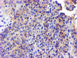 GSTO2 Antibody - IHC of paraffin-embedded Carcinoma of Human bladder tissue using anti-GSTO2 mouse monoclonal antibody.