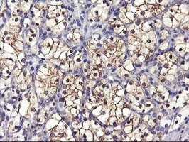 GSTO2 Antibody - IHC of paraffin-embedded Carcinoma of Human kidney tissue using anti-GSTO2 mouse monoclonal antibody.
