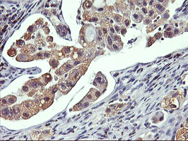 GSTO2 Antibody - IHC of paraffin-embedded Carcinoma of Human lung tissue using anti-GSTO2 mouse monoclonal antibody.