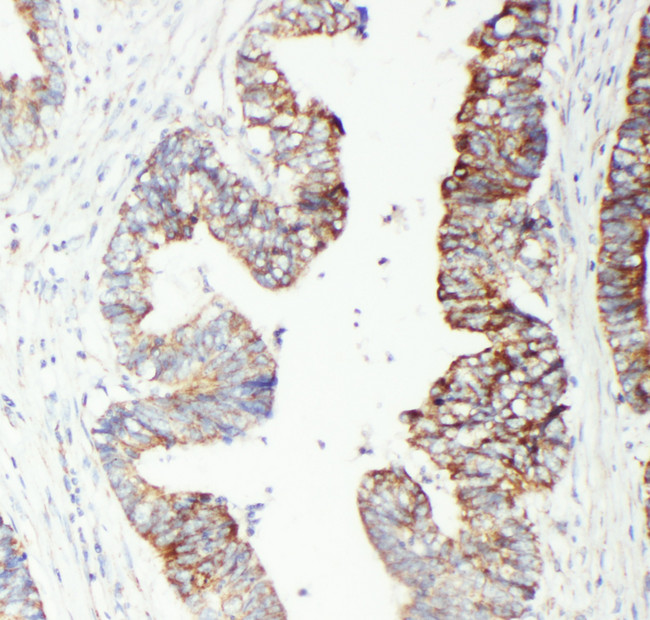 GSTP1 / GST Pi Antibody - GSTP1 / GST Pi antibody. IHC(P): Human Intestinal Cancer Tissue.