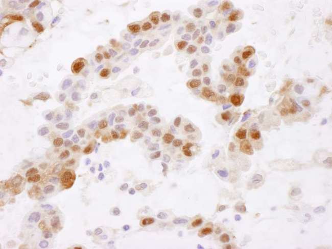 GSTP1 / GST Pi Antibody - Detection of Human GSTP1 by Immunohistochemistry. Sample: FFPE section of human lung carcinoma. Antibody: Affinity purified rabbit anti-GSTP1 used at a dilution of 1:5000 (0.2 ug/ml). Detection: DAB.