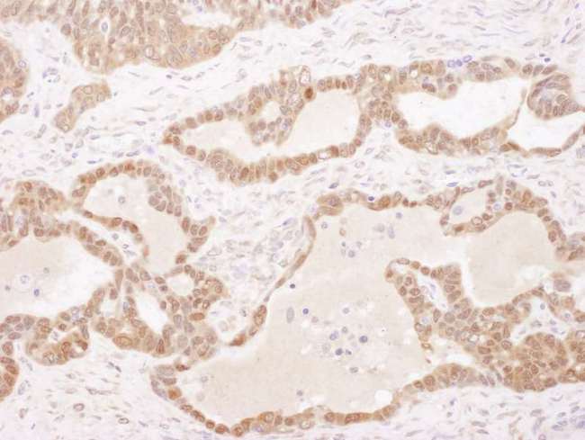 GSTP1 / GST Pi Antibody - Detection of Human GSTP1 by Immunohistochemistry. Sample: FFPE section of human ovarian carcinoma. Antibody: Affinity purified rabbit anti-GSTP1 used at a dilution of 1:5000 (0.2 ug/ml). Detection: DAB.