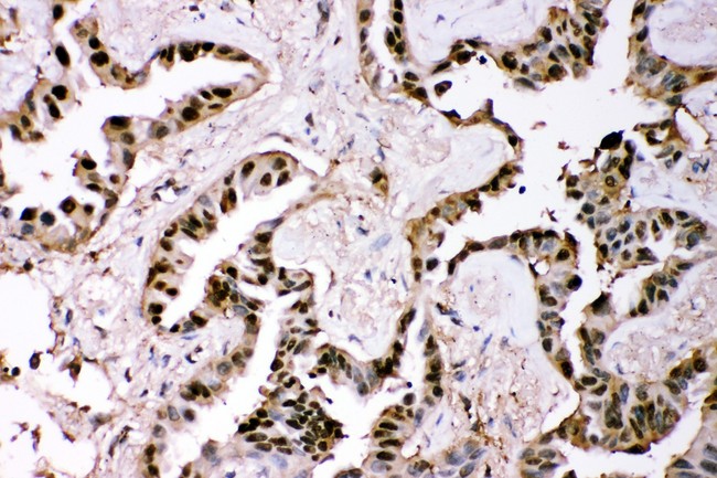 GSTP1 / GST Pi Antibody - GST3/GST pi antibody IHC-paraffin: Human Lung Cancer Tissue.