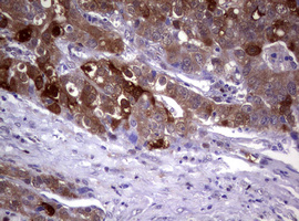 GSTP1 / GST Pi Antibody - IHC of paraffin-embedded Adenocarcinoma of Human colon tissue using anti-GSTP1 mouse monoclonal antibody. (Heat-induced epitope retrieval by 10mM citric buffer, pH6.0, 120°C for 3min).