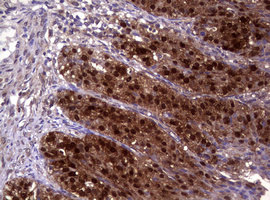 GSTP1 / GST Pi Antibody - IHC of paraffin-embedded Adenocarcinoma of Human ovary tissue using anti-GSTP1 mouse monoclonal antibody. (Heat-induced epitope retrieval by 10mM citric buffer, pH6.0, 120°C for 3min).