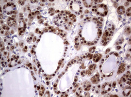 GSTP1 / GST Pi Antibody - IHC of paraffin-embedded Carcinoma of Human thyroid tissue using anti-GSTP1 mouse monoclonal antibody. (Heat-induced epitope retrieval by 10mM citric buffer, pH6.0, 120°C for 3min).