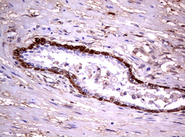 GSTP1 / GST Pi Antibody - IHC of paraffin-embedded Carcinoma of Human prostate tissue using anti-GSTP1 mouse monoclonal antibody. (Heat-induced epitope retrieval by 10mM citric buffer, pH6.0, 120°C for 3min).