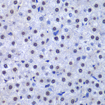 GSTP1 / GST Pi Antibody - Immunohistochemistry of paraffin-embedded human liver cancer tissue.