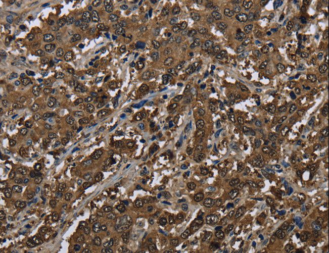 GSTP1 / GST Pi Antibody - Immunohistochemistry of paraffin-embedded Human liver cancer using GSTP1 Polyclonal Antibody at dilution of 1:60.
