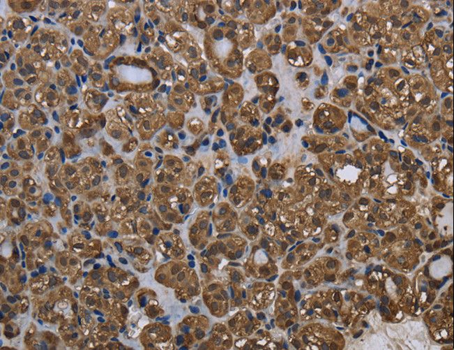 GSTP1 / GST Pi Antibody - Immunohistochemistry of paraffin-embedded Human thyroid cancer using GSTP1 Polyclonal Antibody at dilution of 1:60.