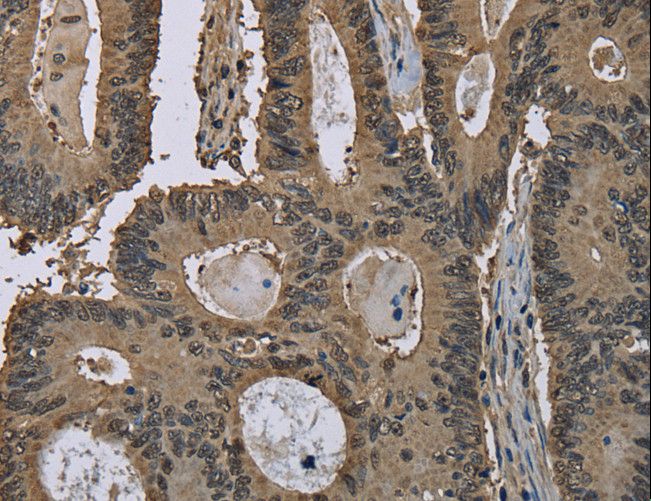 GSTP1 / GST Pi Antibody - Immunohistochemistry of paraffin-embedded Human colon cancer using GSTP1 Polyclonal Antibody at dilution of 1:60.