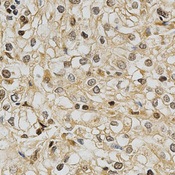 GSTT1 Antibody - Immunohistochemistry of paraffin-embedded human kidney cancer tissue.