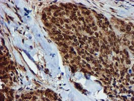GSTT2 Antibody - IHC of paraffin-embedded Adenocarcinoma of Human breast tissue using anti-GSTT2 mouse monoclonal antibody.