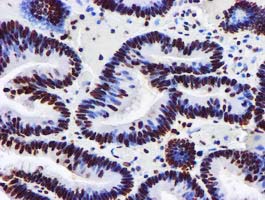 GSTT2 Antibody - IHC of paraffin-embedded Adenocarcinoma of Human colon tissue using anti-GSTT2 mouse monoclonal antibody.