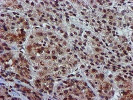 GSTT2 Antibody - IHC of paraffin-embedded Carcinoma of Human liver tissue using anti-GSTT2 mouse monoclonal antibody.