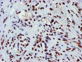 GSTT2 Antibody - IHC of paraffin-embedded Carcinoma of Human lung tissue using anti-GSTT2 mouse monoclonal antibody.