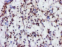 GSTT2 Antibody - IHC of paraffin-embedded Carcinoma of Human kidney tissue using anti-GSTT2 mouse monoclonal antibody.