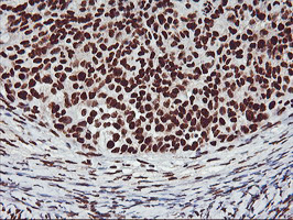 GSTT2 Antibody - IHC of paraffin-embedded Adenocarcinoma of Human ovary tissue using anti-GSTT2 mouse monoclonal antibody.