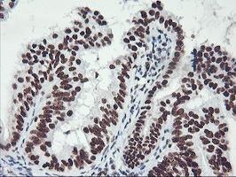 GSTT2 Antibody - IHC of paraffin-embedded Adenocarcinoma of Human endometrium tissue using anti-GSTT2 mouse monoclonal antibody.