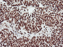 GSTT2 Antibody - IHC of paraffin-embedded Carcinoma of Human bladder tissue using anti-GSTT2 mouse monoclonal antibody.