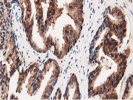 GSTT2 Antibody - IHC of paraffin-embedded Carcinoma of Human prostate tissue using anti-GSTT2 mouse monoclonal antibody.