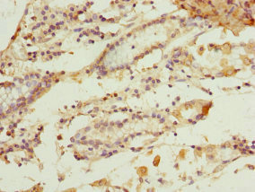 GSTZ1 Antibody - Immunohistochemistry of paraffin-embedded human gastric cancer at dilution 1:100