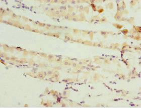 GSTZ1 Antibody - Immunohistochemistry of paraffin-embedded human gastric cancer at dilution 1:100