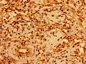 GSX1 / GSH1 Antibody - Immunohistochemistry image of paraffin-embedded human lung cancer at a dilution of 1:100